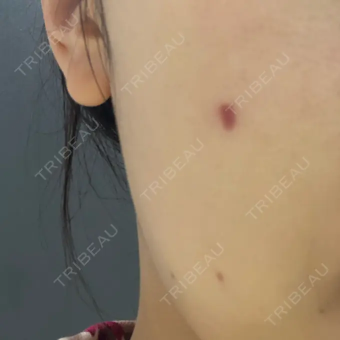 ほくろ・いぼ切除（肌） 吉祥寺アイビークリニック DAY 33 メイン用