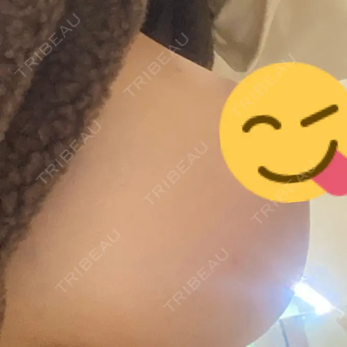 豊胸（脂肪注入） 銀座S美容・形成外科クリニック DAY 31 メイン用