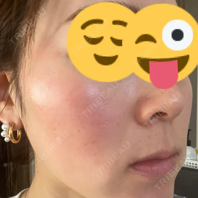 美肌レーザー Rosa Beauty Clinic DAY 5 メイン用