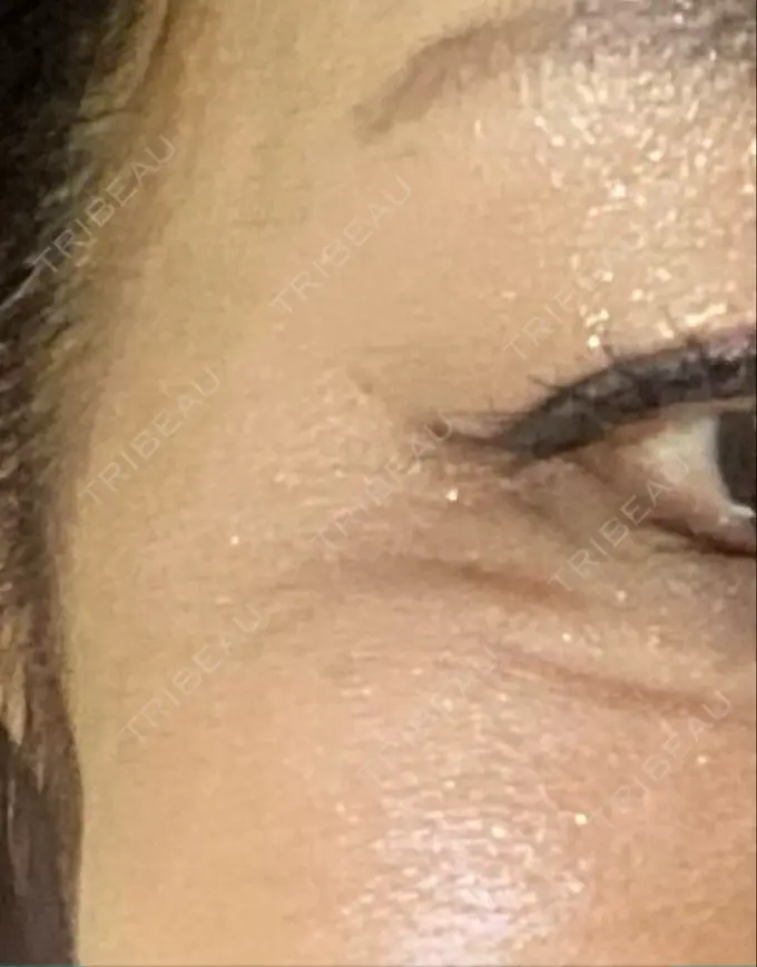 ボトックス（目尻） TCB東京中央美容外科 千葉駅前院 DAY 2 メイン用