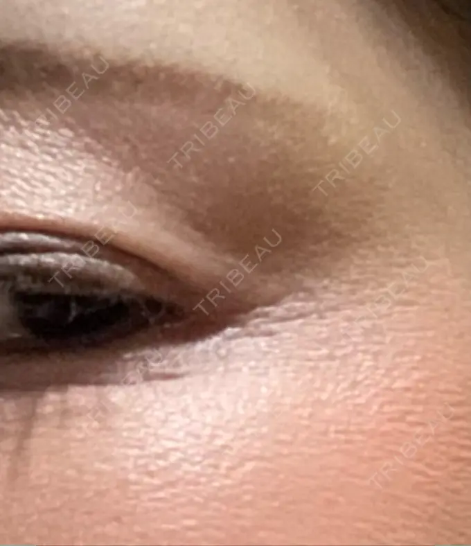 ボトックス（目尻） TCB東京中央美容外科 千葉駅前院 DAY 3 メイン用