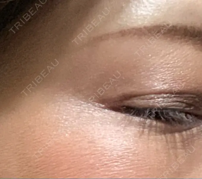 ボトックス（目尻） TCB東京中央美容外科 千葉駅前院 DAY 4 メイン用