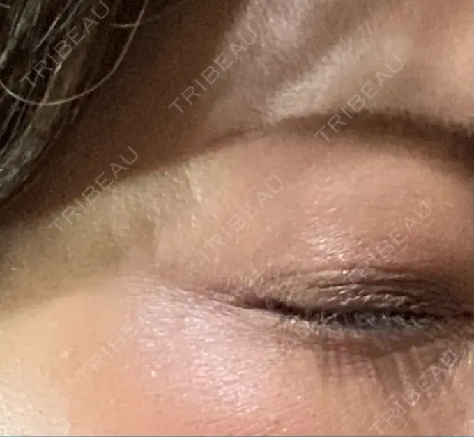 ボトックス（目尻） TCB東京中央美容外科 千葉駅前院 DAY 6 メイン用