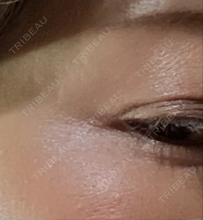 ボトックス（目尻） TCB東京中央美容外科 千葉駅前院 DAY 8 メイン用