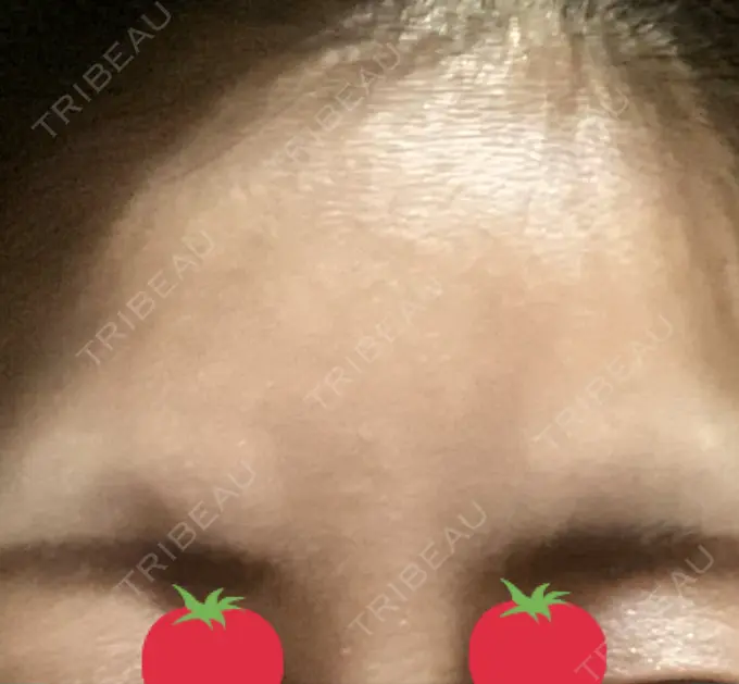 ボトックス（眉間） TCB東京中央美容外科 千葉駅前院 DAY 2 メイン用