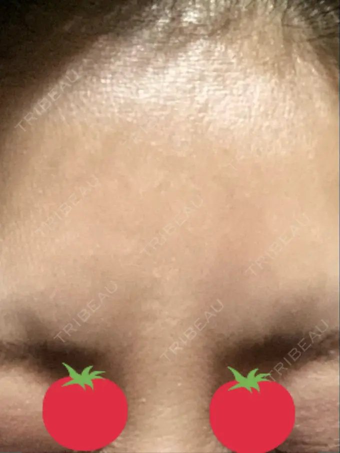 ボトックス（眉間） TCB東京中央美容外科 千葉駅前院 DAY 3 メイン用