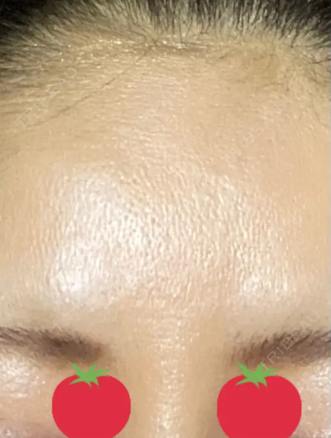 ボトックス（眉間） TCB東京中央美容外科 千葉駅前院 DAY 4 メイン用