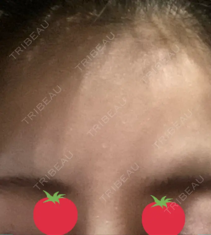 ボトックス（眉間） TCB東京中央美容外科 千葉駅前院 DAY 5 メイン用