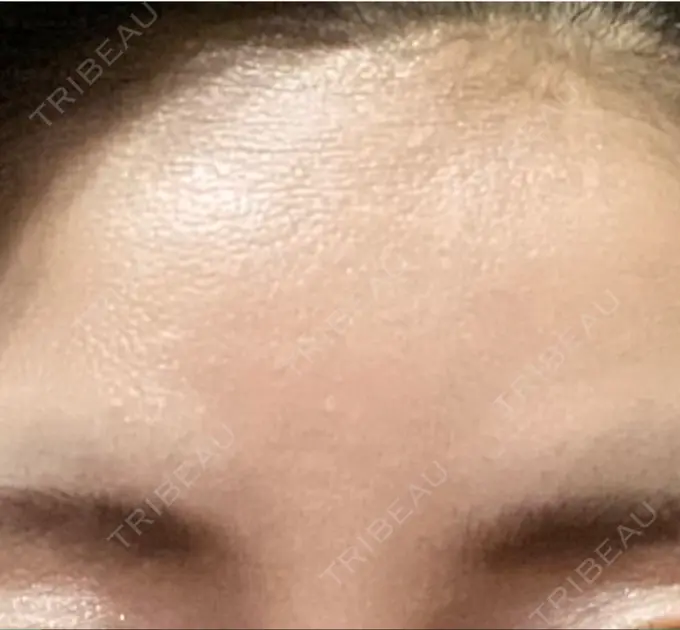 ボトックス（眉間） TCB東京中央美容外科 千葉駅前院 DAY 7 メイン用