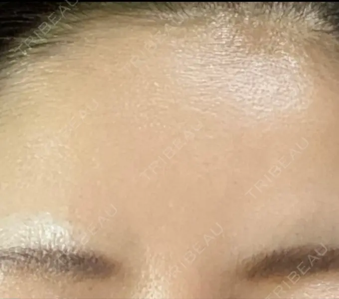 ボトックス（眉間） TCB東京中央美容外科 千葉駅前院 DAY 8 メイン用