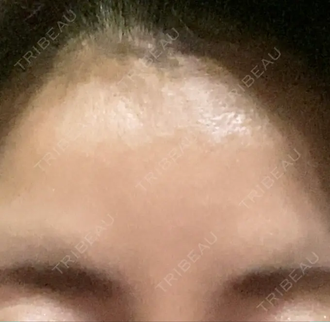 ボトックス（眉間） TCB東京中央美容外科 千葉駅前院 DAY 9 メイン用