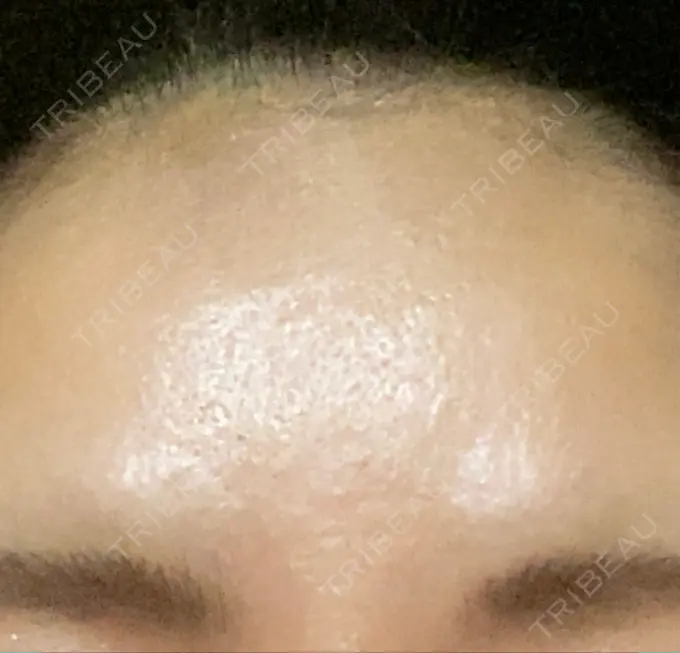 ボトックス（眉間） TCB東京中央美容外科 千葉駅前院 AFTER メイン用