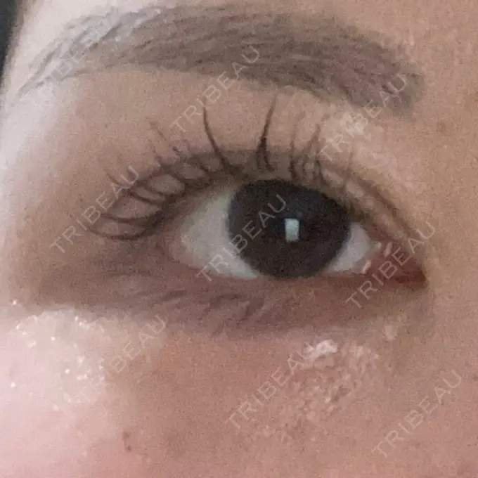 ヒアルロン酸注入（涙袋） / ボトックス（タレ目） アネシス美容クリニック DAY 3 メイン用