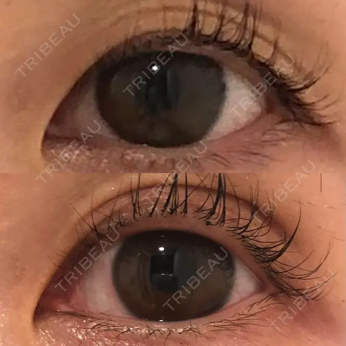 二重埋没 SOL CLINIC DAY 6 メイン用