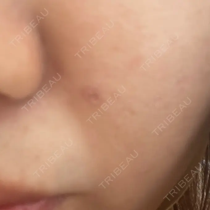 ほくろ・いぼ切除（肌） 吉祥寺アイビークリニック AFTER メイン用