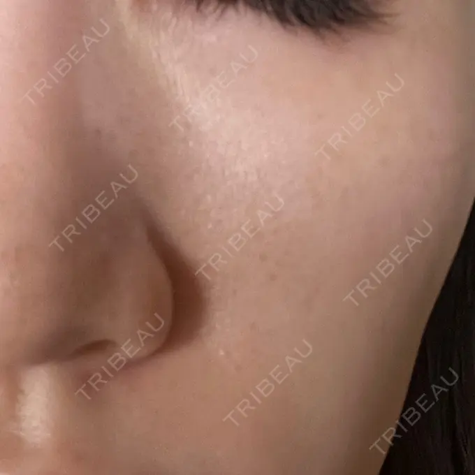 ピコレーザートーニング（美白・肝斑） ルラ美容クリニック 高田馬場院 DAY 0 メイン用