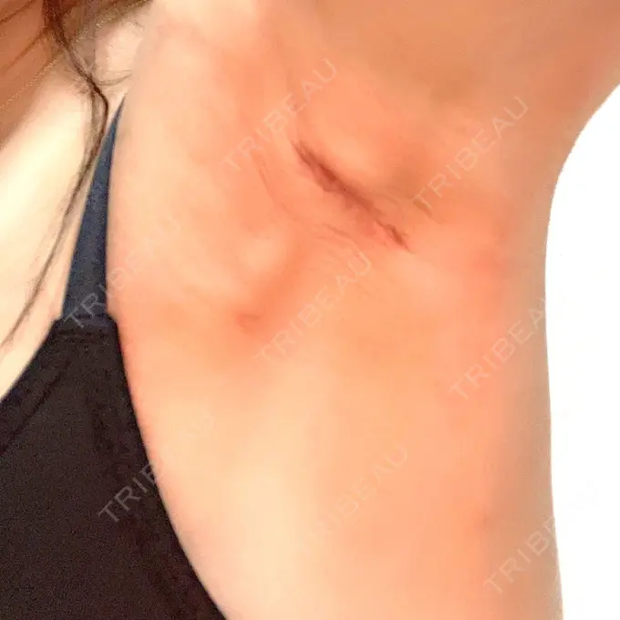 豊胸（シリコンバッグ） / 乳頭縮小 ジョウクリニック 大阪院 DAY 8 メイン用