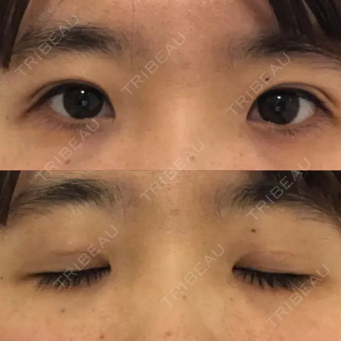 二重埋没 / 眼瞼下垂（非切開） WOM CLINIC GINZA （ワム クリニック ギンザ） DAY 44 メイン用