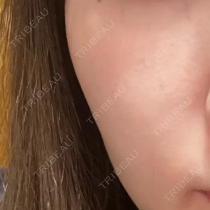 ピコレーザートーニング（美白・肝斑） ルラ美容クリニック 高田馬場院 DAY 1 メイン用