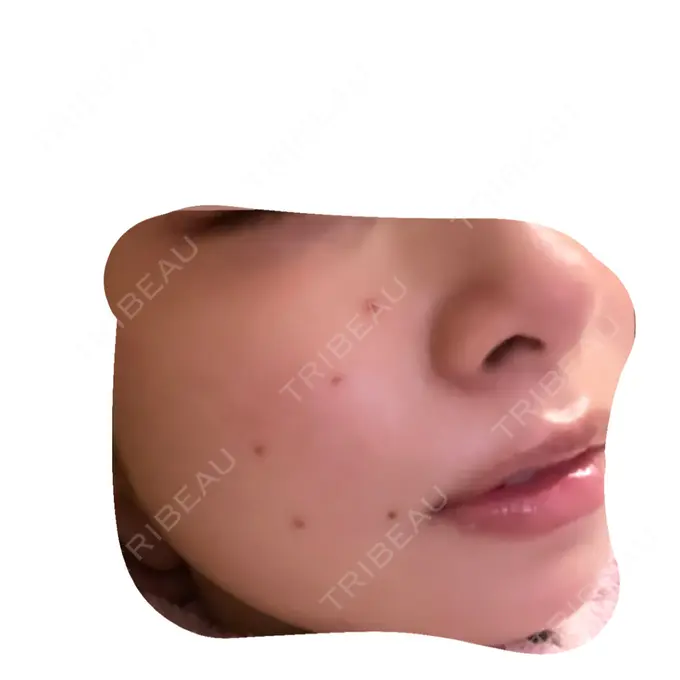 ほくろ・いぼ切除（肌） 吉祥寺アイビークリニック AFTER メイン用