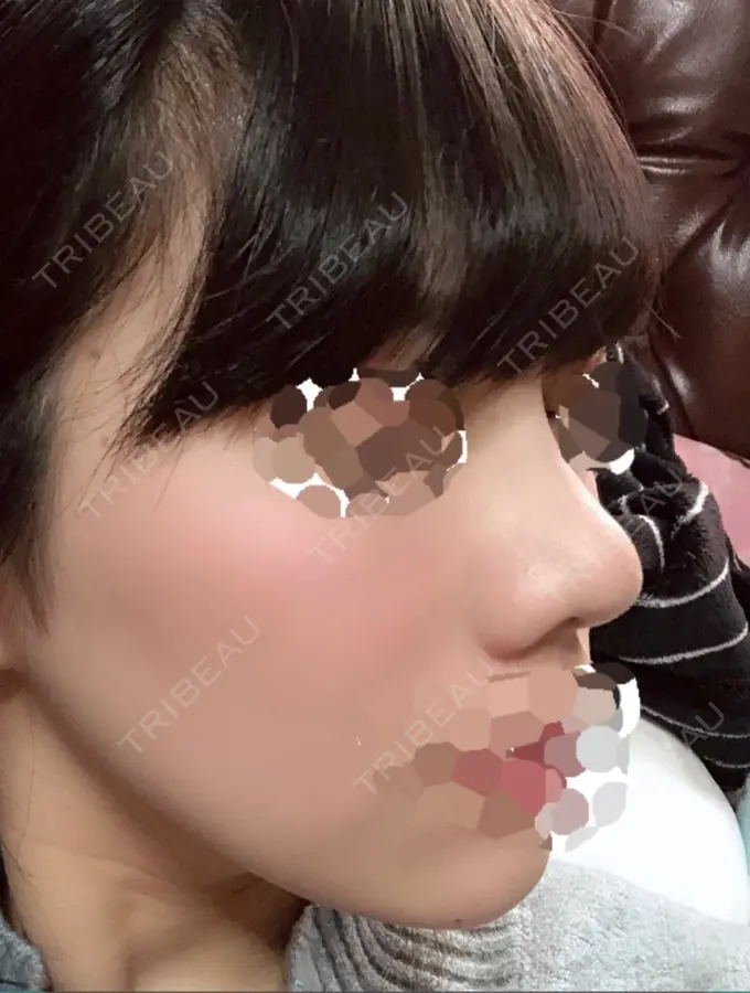 隆鼻術 / 鼻尖形成（切開） / 小鼻縮小（切開） 湘南美容クリニック 岡山院 DAY 31 メイン用