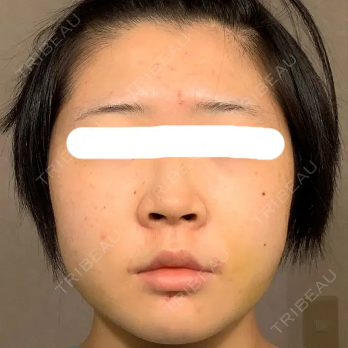 糸リフト / 脂肪吸引（顔） / ジョールファット除去 湘南美容クリニック 銀座院 DAY 13 メイン用