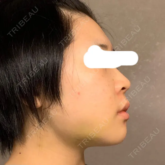 糸リフト / 脂肪吸引（顔） / ジョールファット除去 湘南美容クリニック 銀座院 DAY 13 メイン用