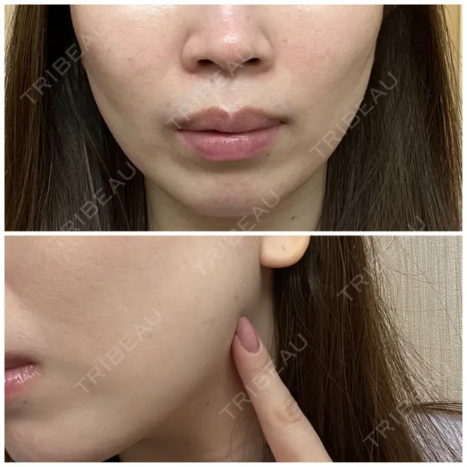 ボトックス（エラ・小顔） LIBER CLINIC DAY 1 メイン用