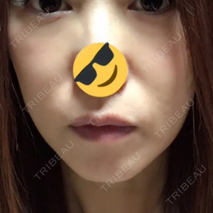 脂肪溶解注射（顔） 湘南美容クリニック 東京蒲田院 AFTER メイン用