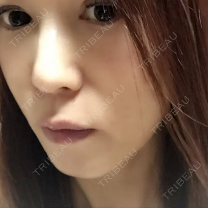 脂肪溶解注射（顔） 湘南美容クリニック 東京蒲田院 DAY 14 メイン用