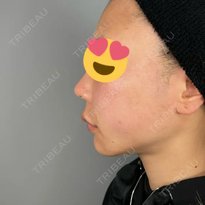 鼻中隔延長（非切開） ASTRA BEAUTY CLINIC DAY 0 メイン用