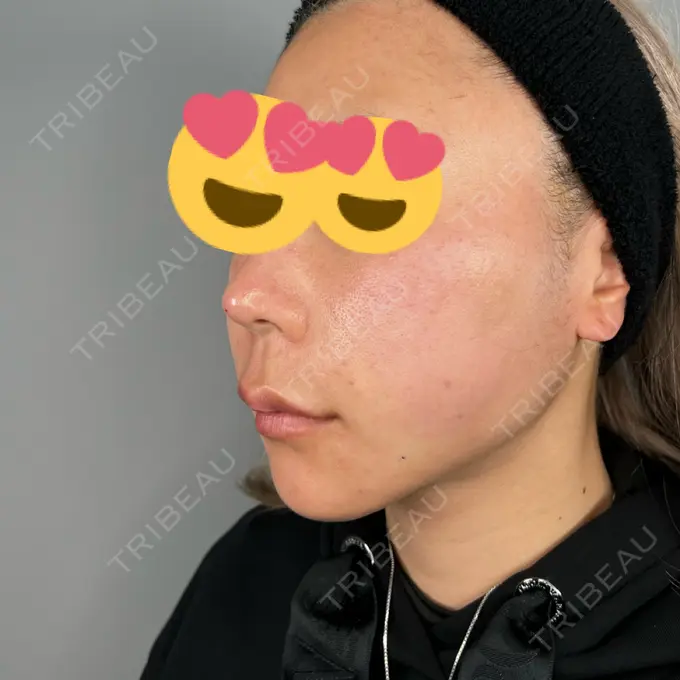 鼻中隔延長（非切開） ASTRA BEAUTY CLINIC DAY 0 メイン用