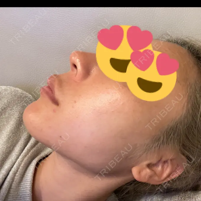 鼻中隔延長（非切開） ASTRA BEAUTY CLINIC DAY 1 メイン用