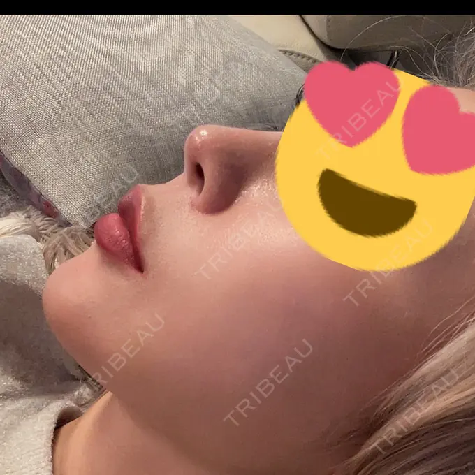 鼻中隔延長（非切開） ASTRA BEAUTY CLINIC DAY 2 メイン用