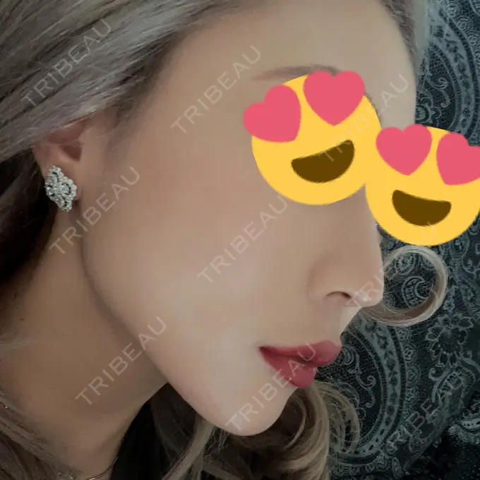 鼻中隔延長（非切開） ASTRA BEAUTY CLINIC AFTER メイン用