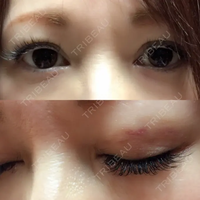 二重埋没 湘南美容クリニック 東京蒲田院 DAY 14 メイン用