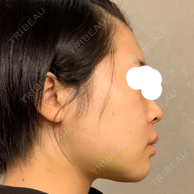 糸リフト / 脂肪吸引（顔） / ジョールファット除去 湘南美容クリニック 銀座院 DAY 16 メイン用