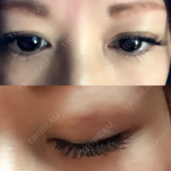 二重埋没 湘南美容クリニック 東京蒲田院 DAY 14 メイン用