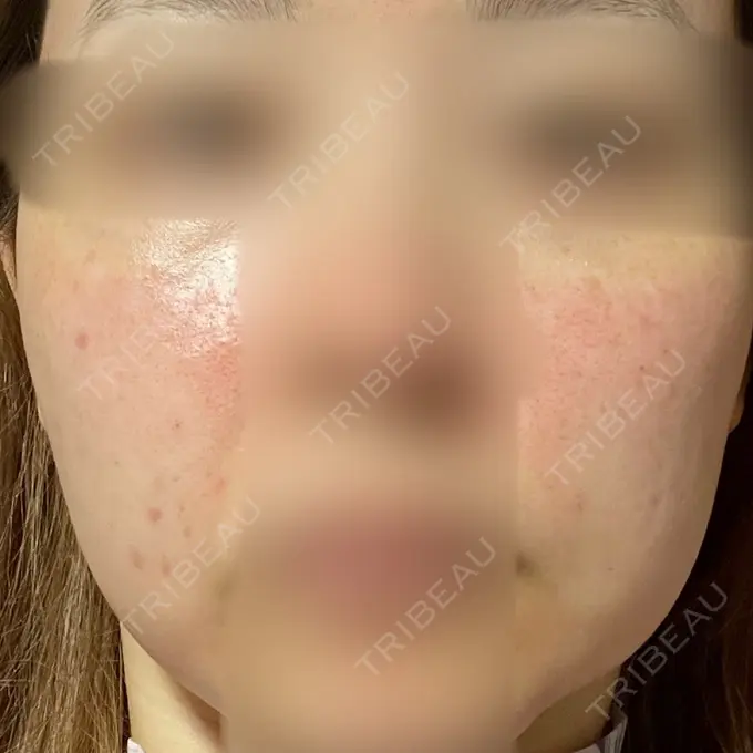 ヴェルヴェットスキン アリエル美容クリニック 大宮院 DAY 0 メイン用