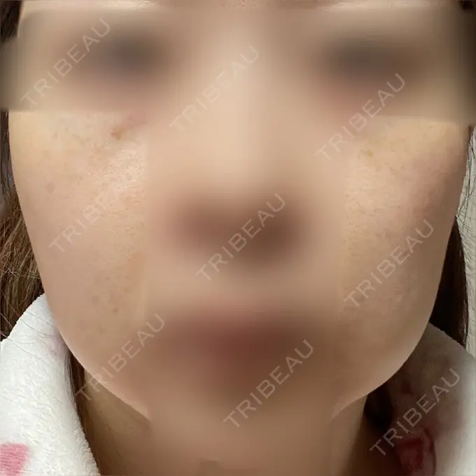 ヴェルヴェットスキン アリエル美容クリニック 大宮院 DAY 43 メイン用