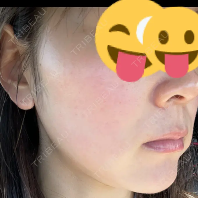 美肌レーザー Rosa Beauty Clinic DAY 16 メイン用