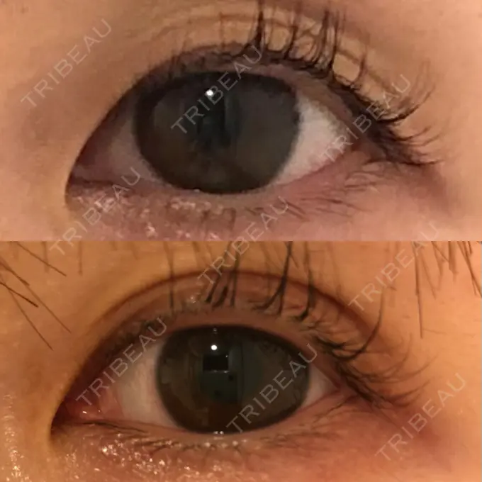 二重埋没 SOL CLINIC DAY 15 メイン用