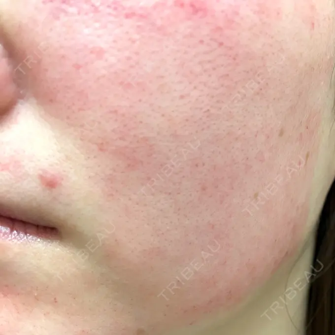 ダーマペン RAISE CLINIC 【レイズクリニック】 DAY 0 メイン用