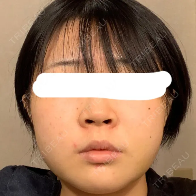 糸リフト / 脂肪吸引（顔） / ジョールファット除去 湘南美容クリニック 銀座院 AFTER メイン用