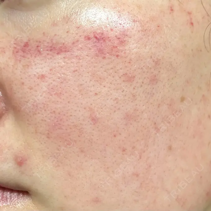 ダーマペン RAISE CLINIC 【レイズクリニック】 DAY 1 メイン用