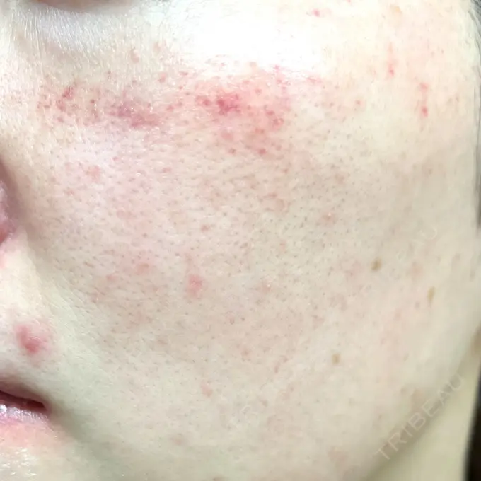 ダーマペン RAISE CLINIC 【レイズクリニック】 DAY 2 メイン用