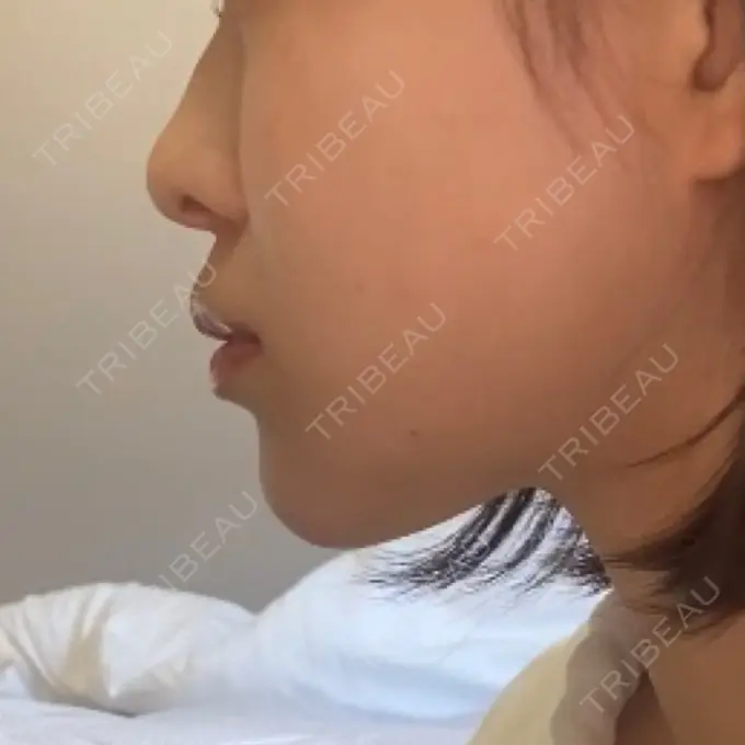 ヒアルロン酸注入（あご） / ボトックス（エラ・小顔） オーキッド美容クリニック東京御徒町 AFTER メイン用