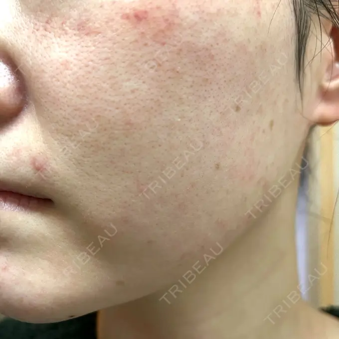 ダーマペン RAISE CLINIC 【レイズクリニック】 DAY 3 メイン用