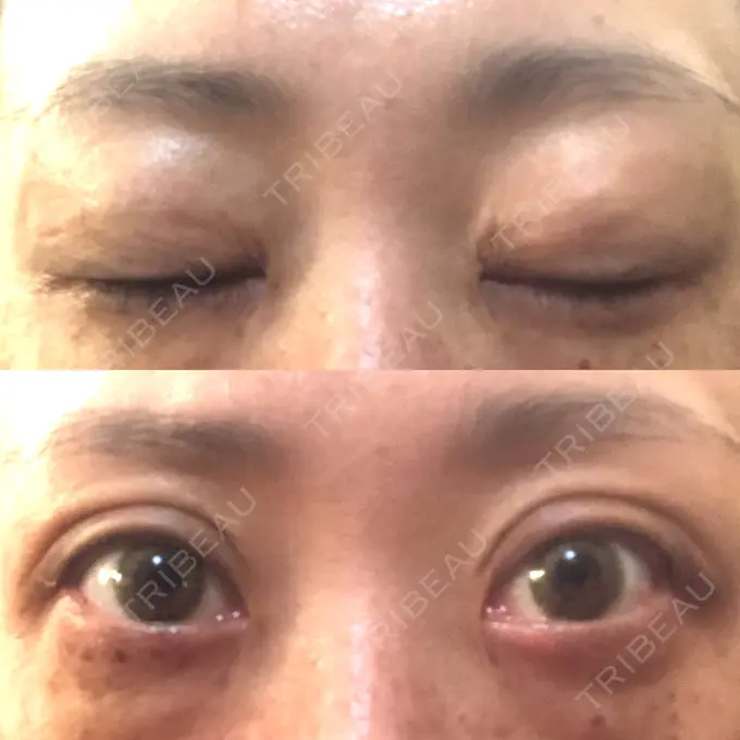 二重埋没 / 目元修正 新宿TAクリニック DAY 36 メイン用