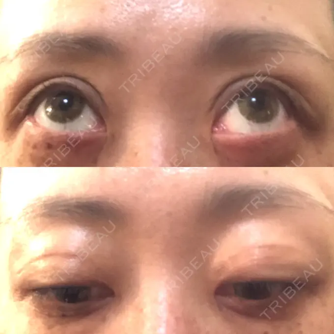 二重埋没 / 目元修正 新宿TAクリニック DAY 36 メイン用